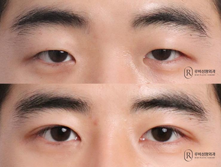 Men's natural adhesion, ptosis correction, epicanthoplasty