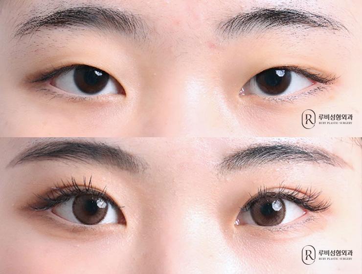 Natural adhesion, ptosis correction