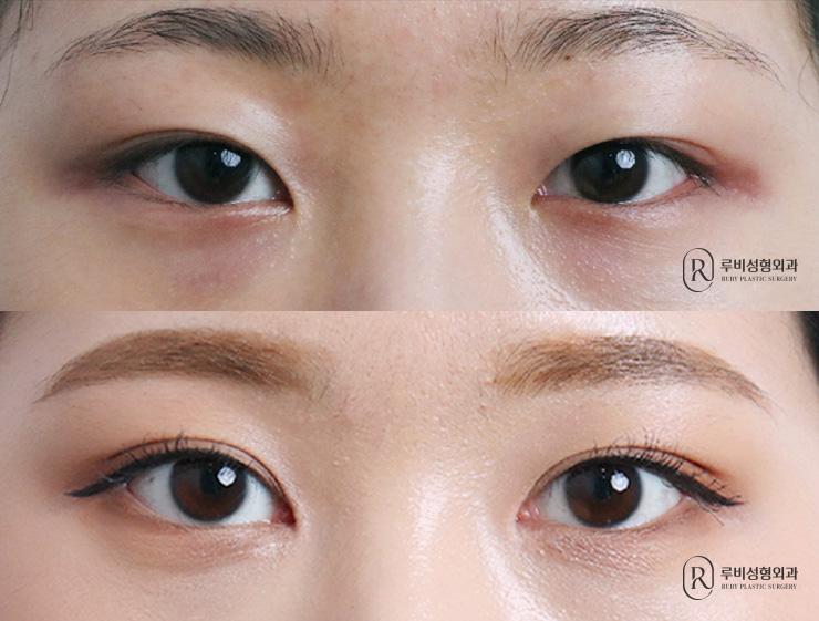 Natural adhesion, ptosis correction, epicanthoplasty