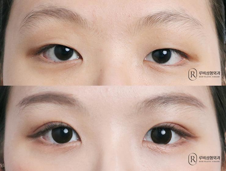 Natural adhesion, ptosis correction