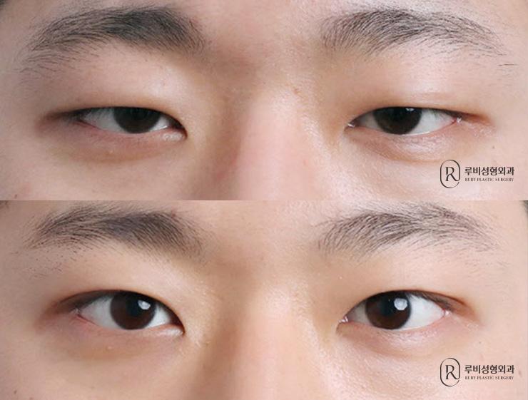 Men's natural adhesion, ptosis correction