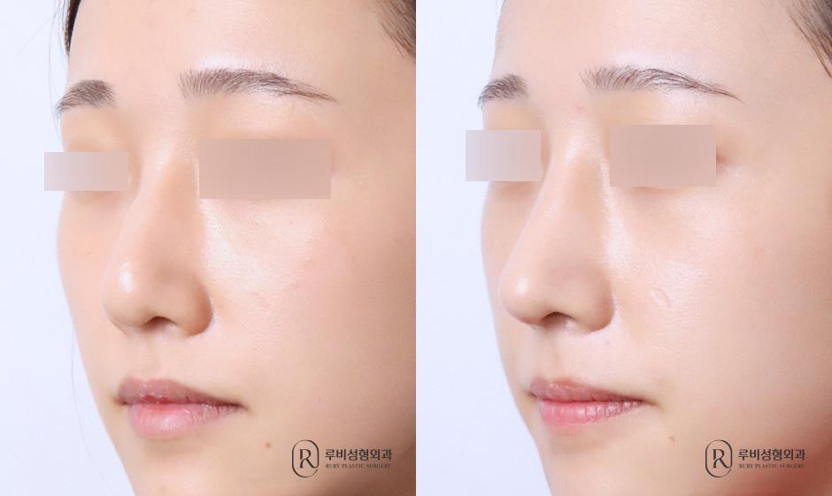 Nose bridge, nose tip, humpectomy, long nose correction
