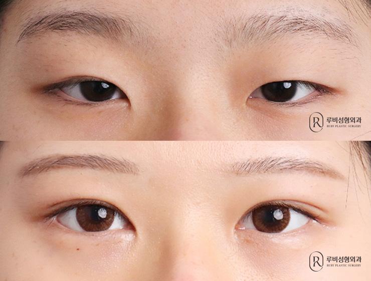 Natural adhesion, ptosis correction, medial, lateral and lower canthoplasty