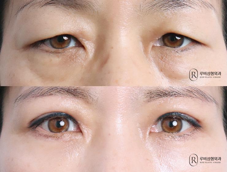 Brow lift, natural adhesion, ptosis correction, lower blepharoplasty, Eye Bag Reposition
