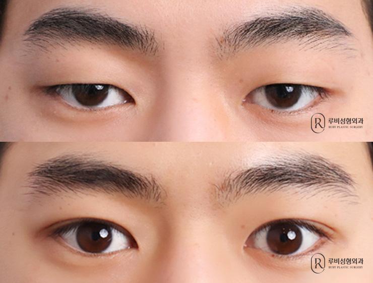 Men's natural adhesion, ptosis correction
