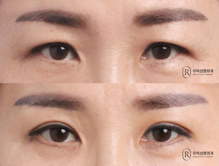 Brow lift, natural adhesion, ptosis correction