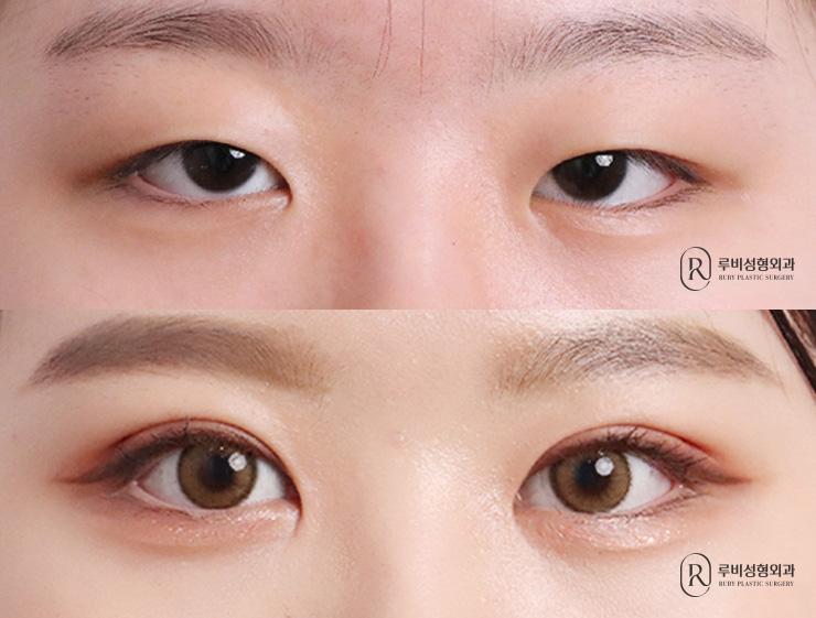 Natural adhesion, ptosis correction