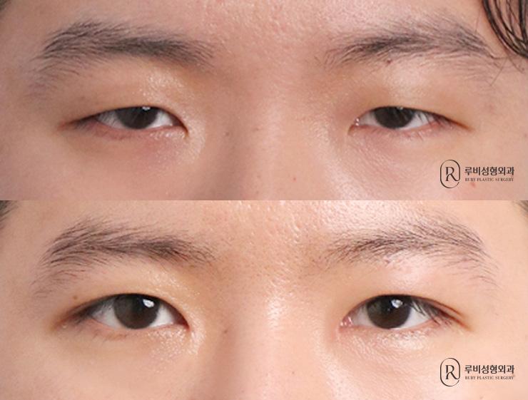 Men's natural adhesion, ptosis correction, epicanthoplasty