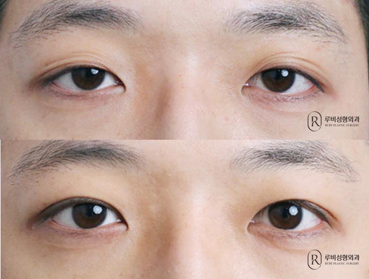 Men's natural adhesion, ptosis correction