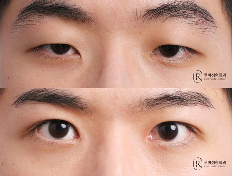 Men's natural adhesion, ptosis correction, epicanthoplasty