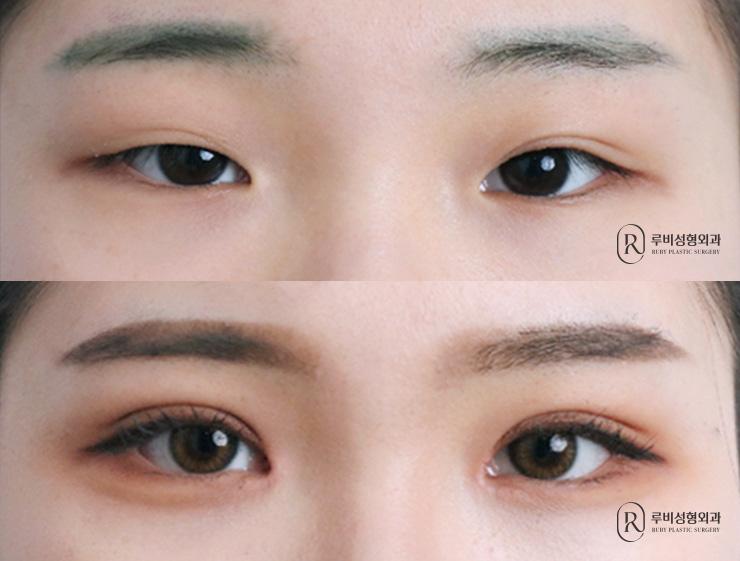 Natural adhesion, ptosis correction, medial and lateral canthoplasty