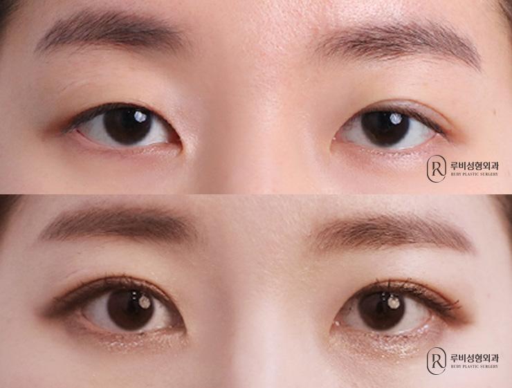 Natural adhesion, ptosis correction