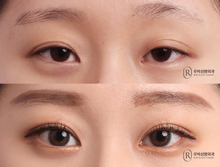 Natural adhesion, ptosis correction