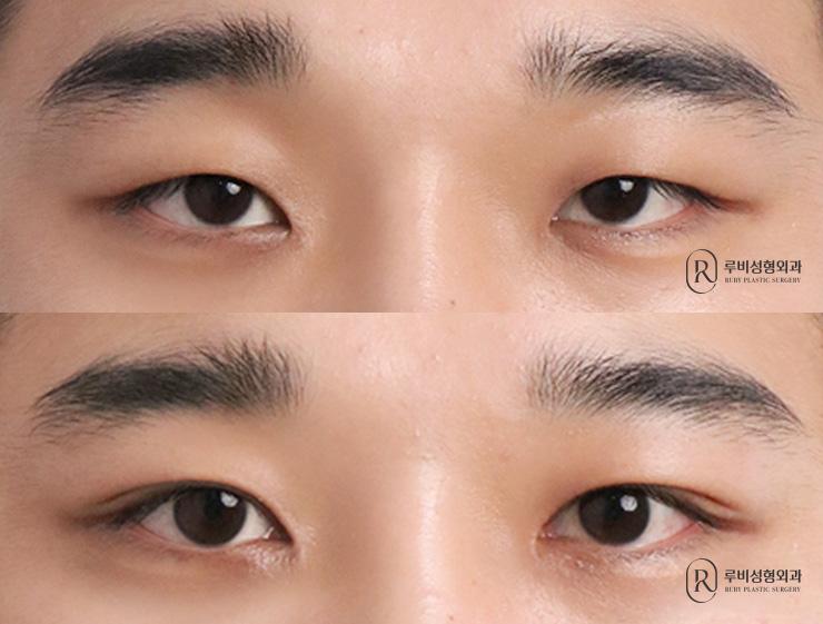 Men's natural adhesion, ptosis correction, epicanthoplasty