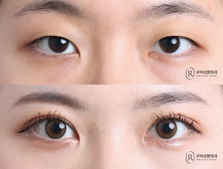 Natural adhesion, ptosis correction, epicanthoplasty