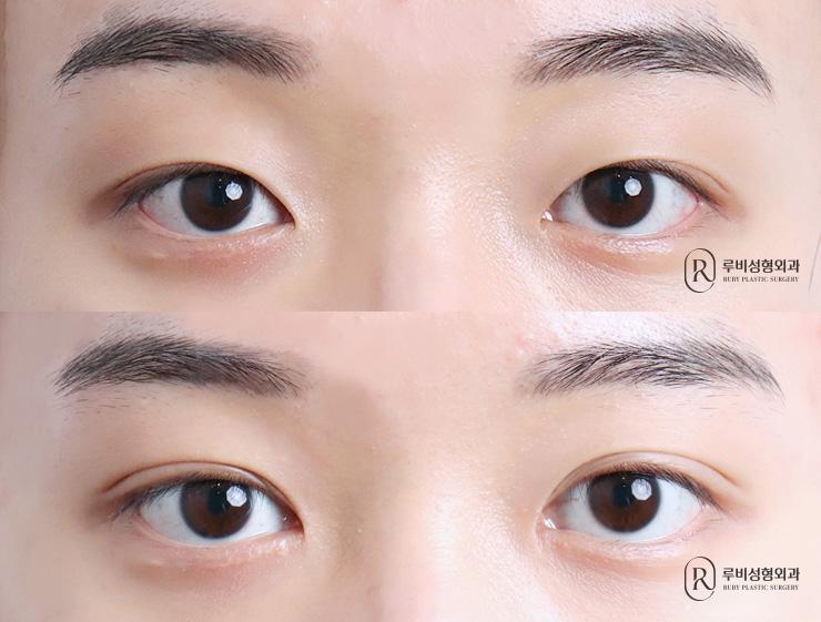 Men's natural adhesion, ptosis correction, epicanthoplasty