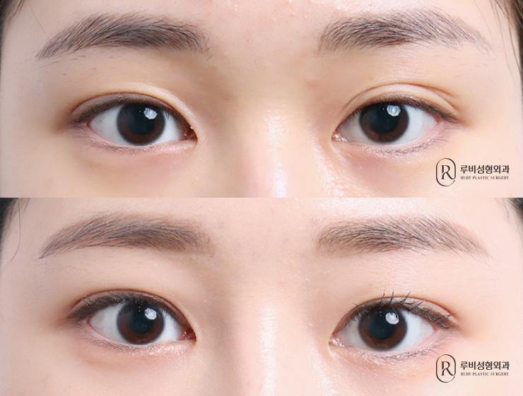 Natural adhesion, ptosis correction
