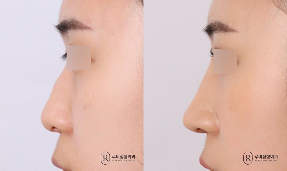 Nose bridge, nose tip, humpectomy, long nose correction