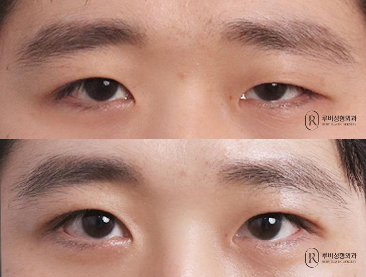 Men's natural adhesion, ptosis correction