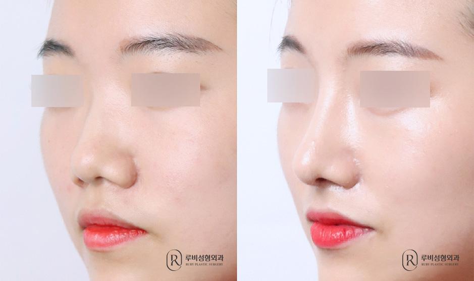 Nose bridge, nose tip, humpectomy, bulbous nose correction