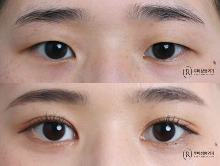 Natural adhesion, ptosis correction, epicanthoplasty