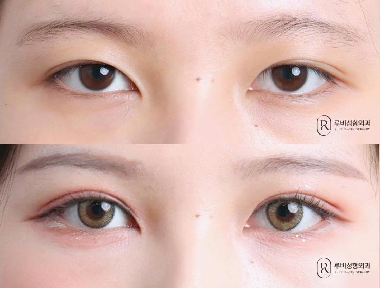 Natural adhesion, ptosis correction, lateral canthoplasty