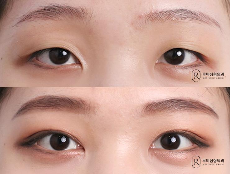 Natural adhesion, ptosis correction, epicanthoplasty