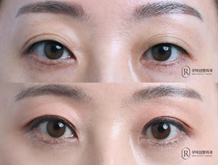 Natural adhesion, ptosis correction