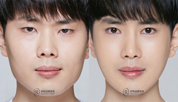 Natural adhesion, ptosis correction, epicanthoplasty, nasal bridge, nasal tip, short nose correction, zygoma reduction, angle reduction