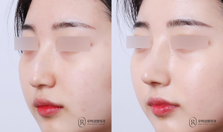 Nose bridge, nose tip, humpectomy, long nose correction