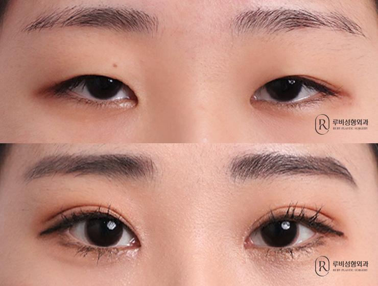 Natural adhesion, ptosis correction, epicanthoplasty