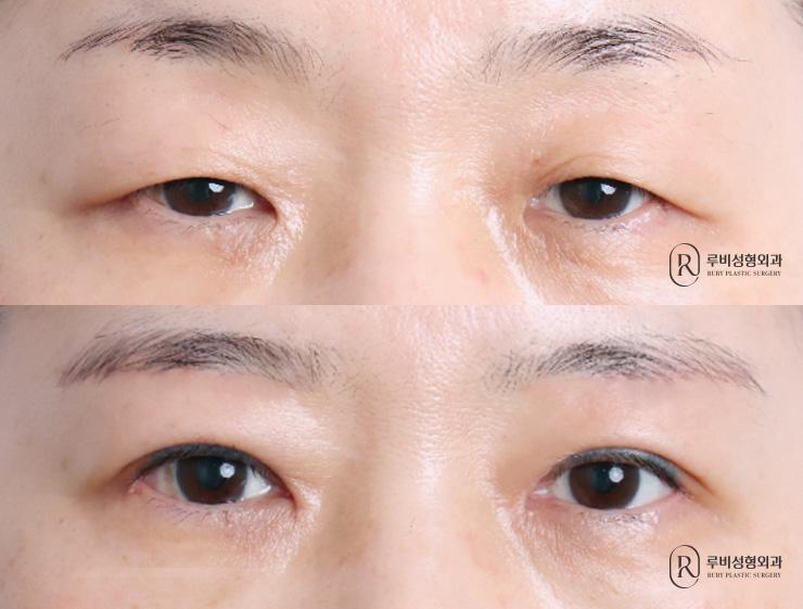 Brow lift, natural adhesion, ptosis correction, medial, lateral and lower canthoplasty