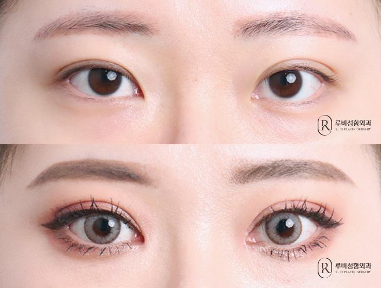 Natural adhesion, ptosis correction, epicanthoplasty