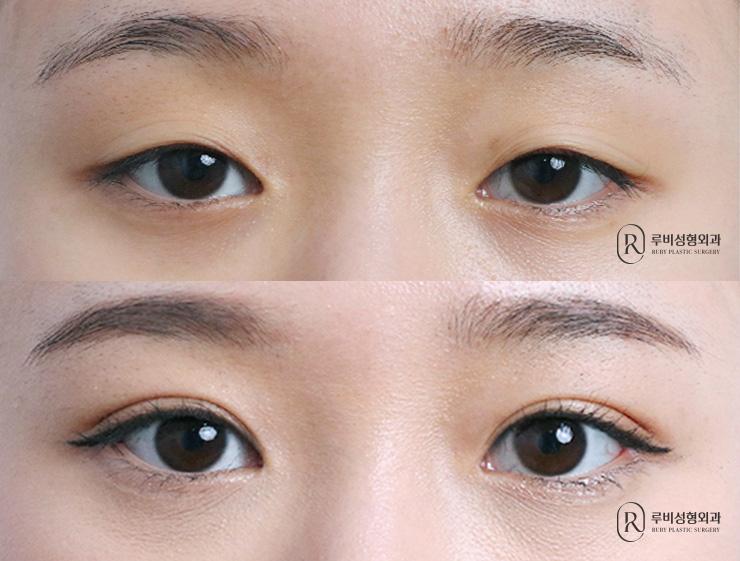 Natural adhesion, ptosis correction, lateral canthoplasty