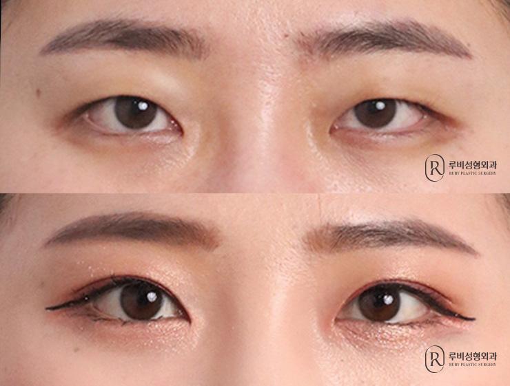 Natural adhesion, ptosis correction