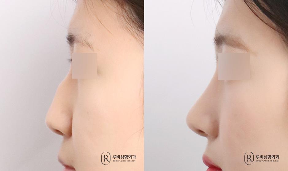 Nose bridge, nose tip, humpectomy, long nose correction