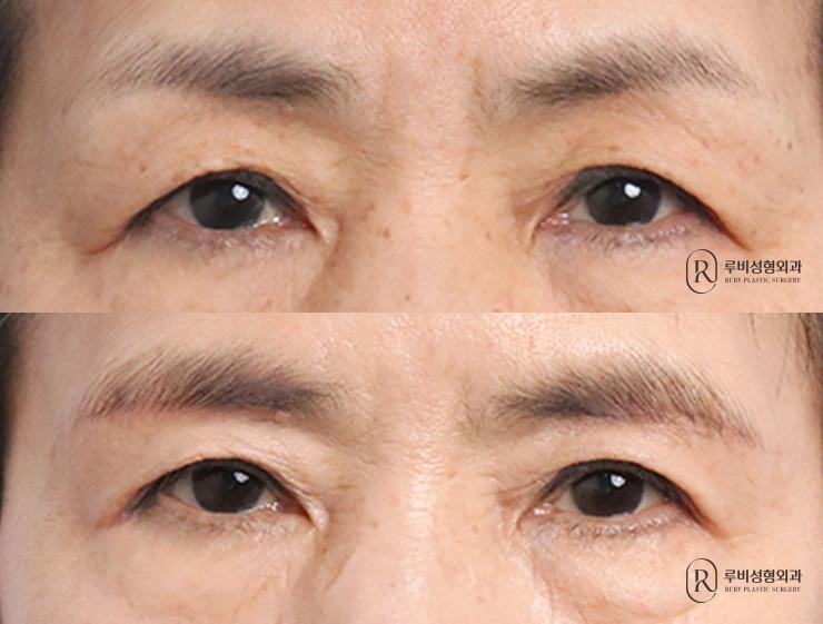 Brow lift