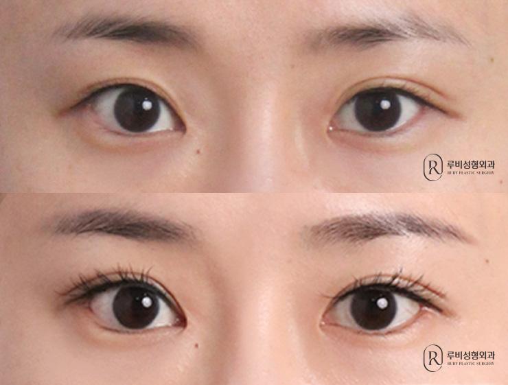Natural adhesion, ptosis correction, medial, lateral and lower canthoplasty