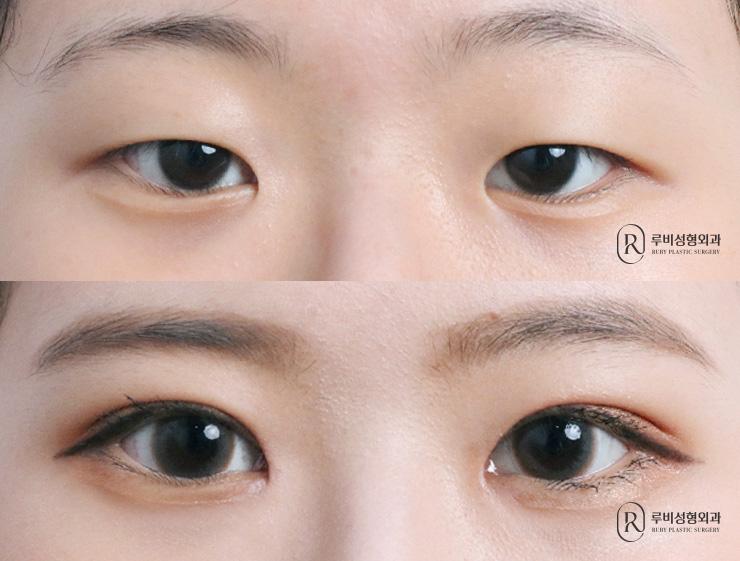 Natural adhesion, ptosis correction, epicanthoplasty