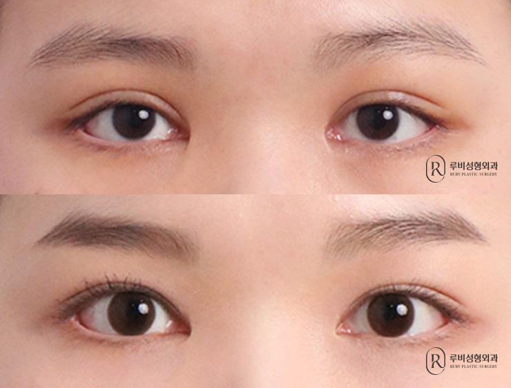 Natural adhesion, ptosis correction, revision surgery
