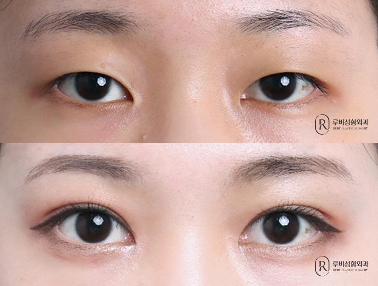 Natural adhesion, ptosis correction, epicanthoplasty
