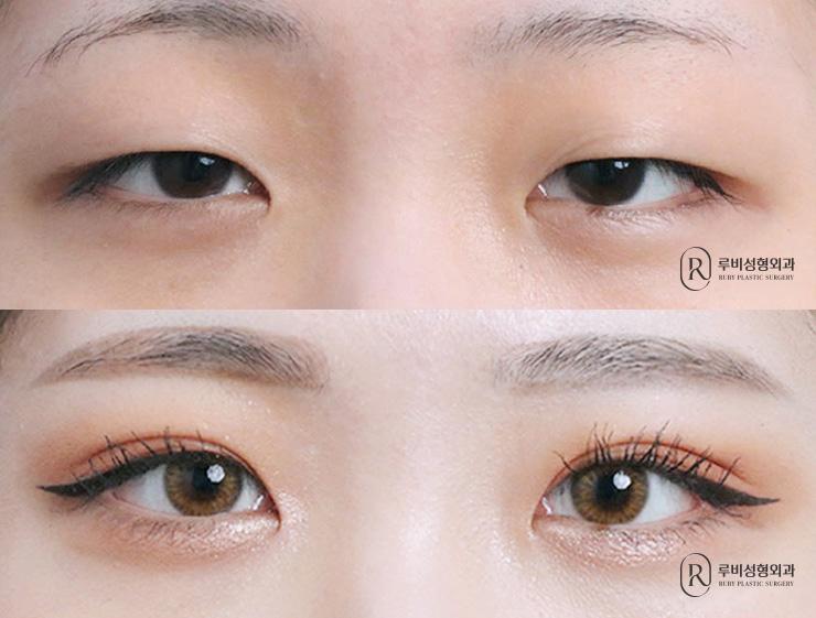 Natural adhesion, ptosis correction