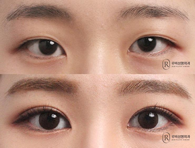 Natural adhesion, ptosis correction