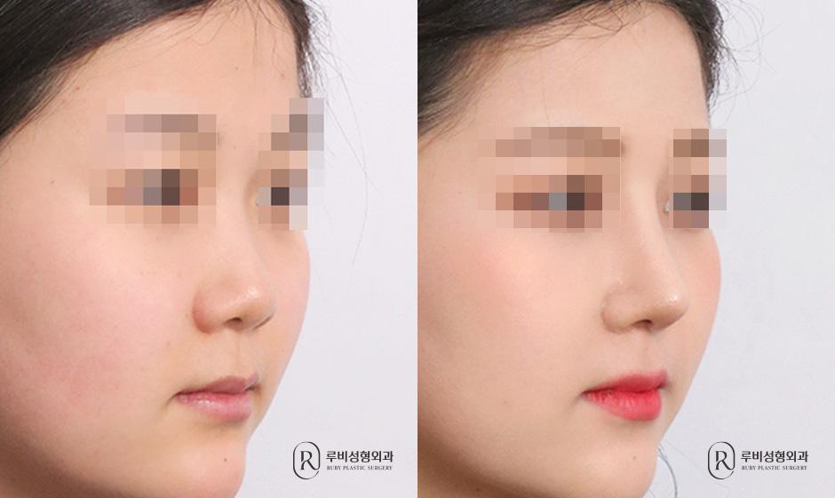 Nasal bridge, nasal tip, short nose correction