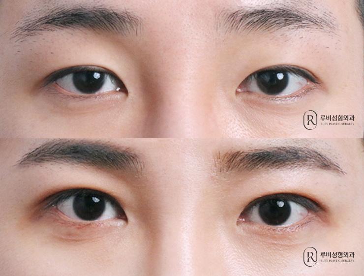 Men's natural adhesion, ptosis correction, revision surgery