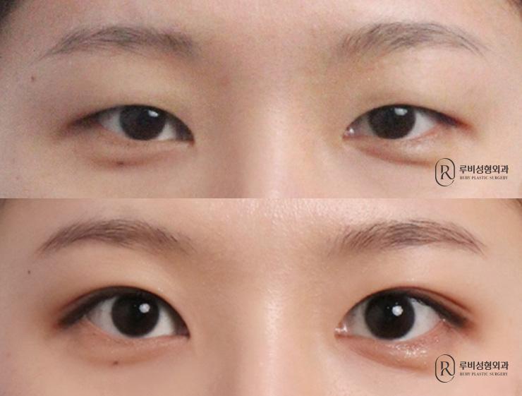 Natural adhesion, ptosis correction