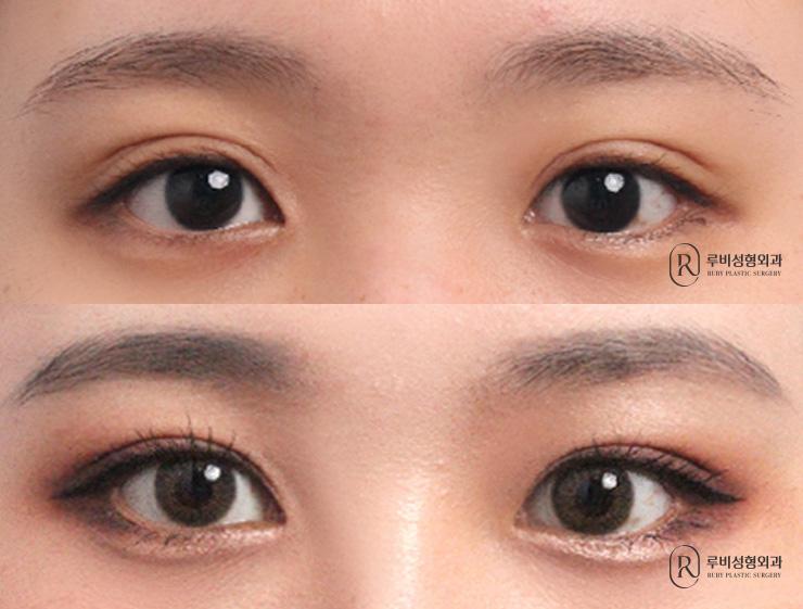 Natural adhesion, ptosis correction