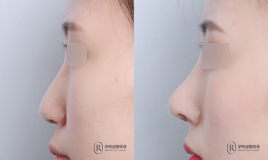 Nasal bridge, nasal tip, long nose correction