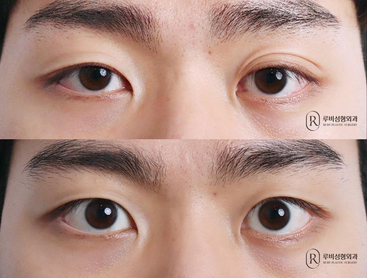 Men's natural adhesion, ptosis correction