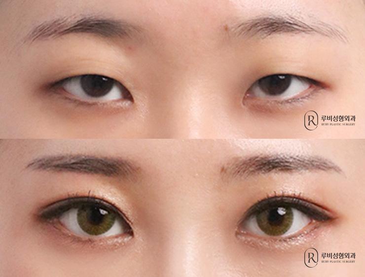 Natural adhesion, ptosis correction